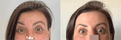 Case 5993 - 45-54 year old woman treated with Botox