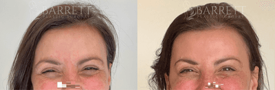 Case 5994 - 45-54 year old woman treated with Botox