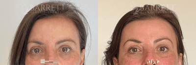 Case 5995 - 45-54 year old woman treated with Botox
