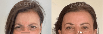 Case 5996 - 45-54 year old woman treated with Botox