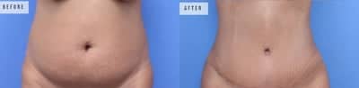 Case 6 - Woman treated with Tummy Tuck, Liposuction