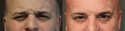 Case 6028 - Hyperconcentrated Botox