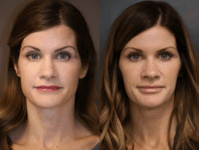 Case 6174 - Filler Rebalancing