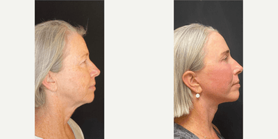 Case 6225 - 60 year old woman treated with Botox
