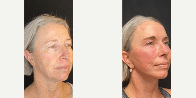 Case 6226 - 60 year old woman treated with Botox
