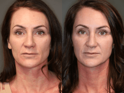 Case 6278 - Filler and Botox Around Eyes