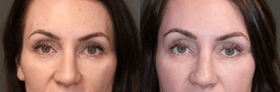 Case 6279 - Filler and Botox Around Eyes