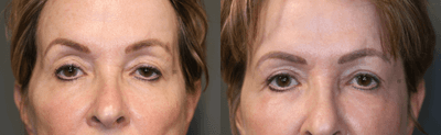 Case 6283 - Brow and Upper Eyelid Evening