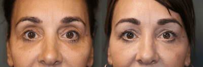 Case 6294 - Pan Facial Rejuvenation