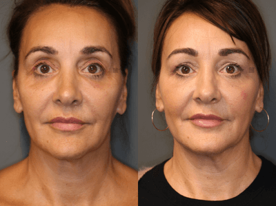 Case 6295 - Pan Facial Rejuvenation