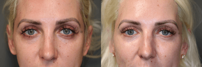 Case 6302 - Lower Eyelid Filler Revision