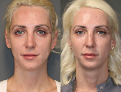 Case 6303 - Lower Eyelid Filler Revision
