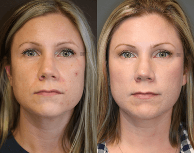 Case 6306 - 3 Years After Filler and Botox