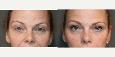 Case 6328 - Lower Lid Filler and Botox