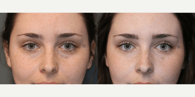 Case 6382 - Lower Lid Filler and Botox