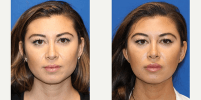 Case 6422 - 25-34 year old woman treated with Botox in masseters for facial slimming