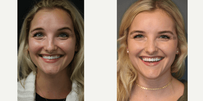 Case 6430 - 8 Months After First Wrinkle Treatment