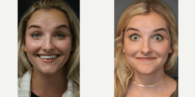 Case 6431 - 8 Months After First Wrinkle Treatment