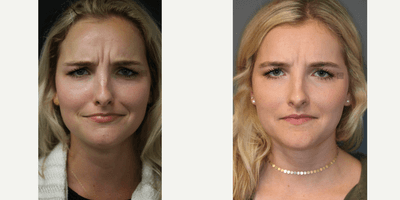 Case 6432 - 8 Months After First Wrinkle Treatment