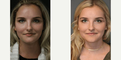 Case 6433 - 8 Months After First Wrinkle Treatment