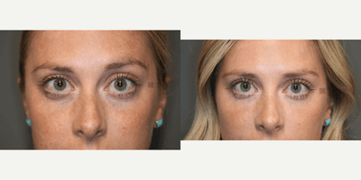 Case 6455 - Botox and Under Eye Volume