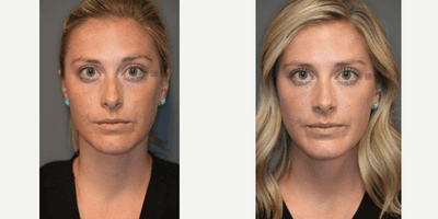 Case 6456 - Botox and Under Eye Volume