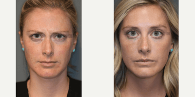 Case 6457 - Botox