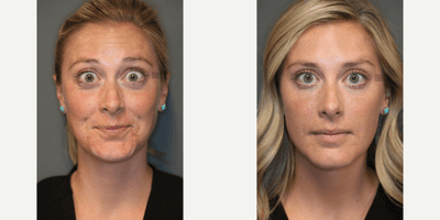 Case 6458 - Botox