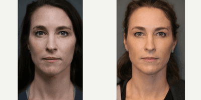 Case 6490 - Maintenance Filler, Microneedling, Neuromodulator
