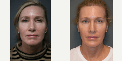 Case 6496 - Facial Shaping Rejuvenation and Maintenance