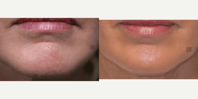 Case 6497 - Facial Shaping Rejuvenation and Maintenance