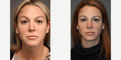 Case 6498 - Botox And Filler To Lower Lids