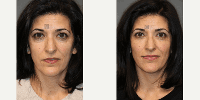 Case 6501 - Under Eye Dark Circles