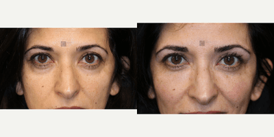 Case 6502 - Under Eye Dark Circles