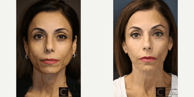 Case 6553 - Jawline Facial Shaping