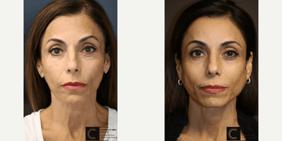 Case 6554 - Jawline Facial Shaping