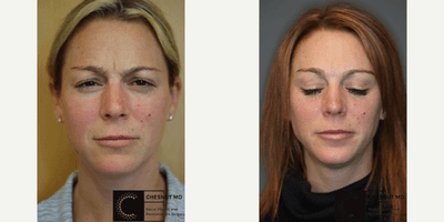 Case 6582 - Botox