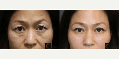 Case 6584 - Botox