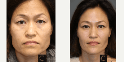 Case 6585 - Botox