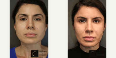 Case 6602 - Facial balancing with neuromodulator