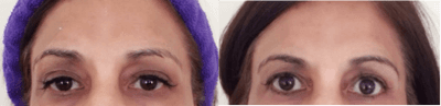 Case 6700 - 45-54 year old woman treated with Botox