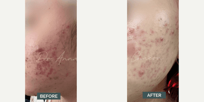 Case 6826 - Woman treated with Accutane