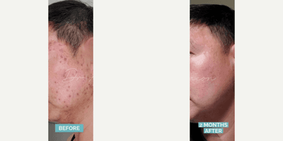 Case 6827 - Man treated with Accutane