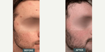 Case 6834 - Man treated with Accutane