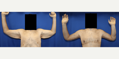 Case 6916 - 25-34 year old man treated with Arm Lift