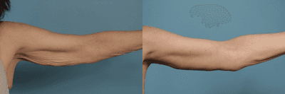 Case 6988 - Patient treated with Arm Lift
