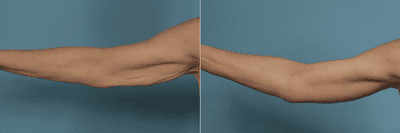 Case 6989 - Patient treated with Arm Lift