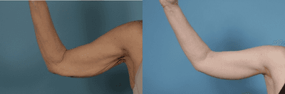 Case 6990 - Patient treated with Arm Lift