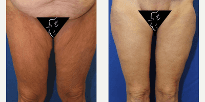 Case 7029 - 45-54 year old woman treated with Thigh Lift