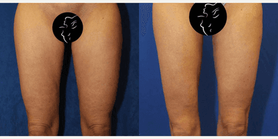 Case 7033 - 35-44 year old woman treated with Thigh Lift